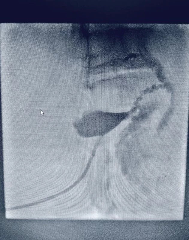 Radiologický snímek po CT navigové perkutální cholecystostomie.