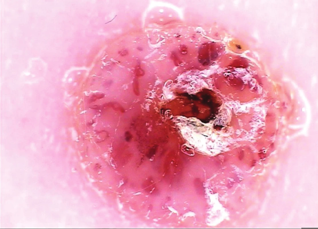 Névus Spitzové atypický – histologicky
Dítě 4 roky, krátká anamnéza trvání (měsíce). Dermatoskopicky dobře ohraničená léze, bez pigmentu, světle růžové pozadí, polymorfní cévní struktury poměrně pravidelně radiálně uspořádané kolem centrální krusty. Dermatoskopický nález vylučuje hemangiom a pyogenní granulom, které přicházejí v úvahu klinicky i s ohledem na věk pacienta, dále není specifický.