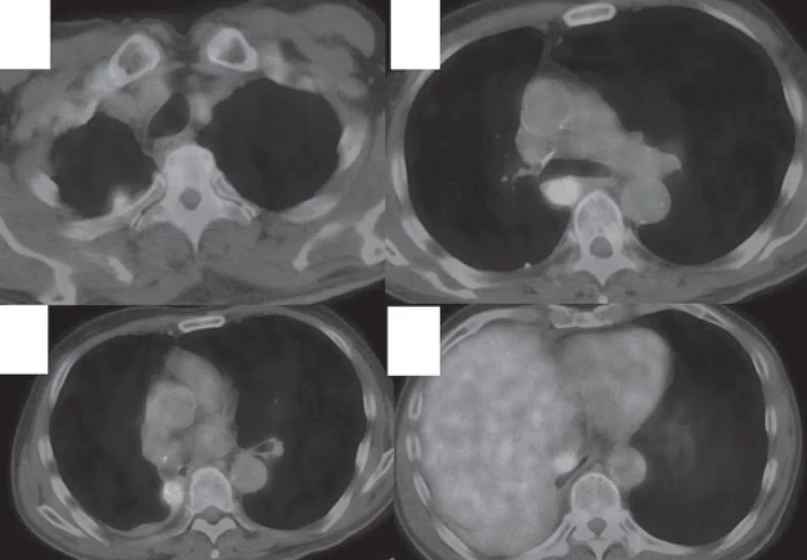 PET/CT scan 6 months after surgery revealed pleural dissemination (A, B) and recurrence in mediastinal lymph nodes (C, D).