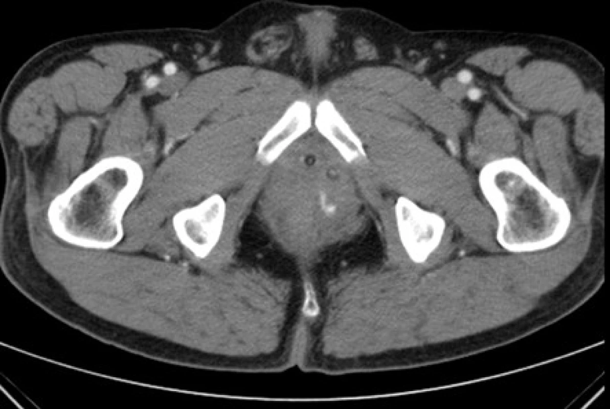 <i>CT – arteriální leak vlevo po prostatektomii – transverzální řez</i>
Fig. 3. <i>CT scan: arterial leak on left side after the prostatectomy – transverse view</i>