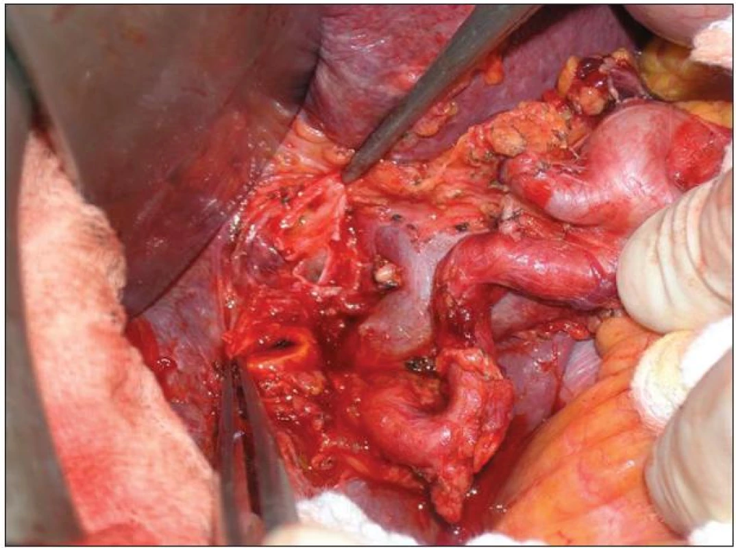 Lymfadenektomie hilu jater a hepatoduodenálního ligamenta v rozsahu N1
Fig. 11: Lymphadenectomy of the liver hilus and hepatoduodenale ligament
