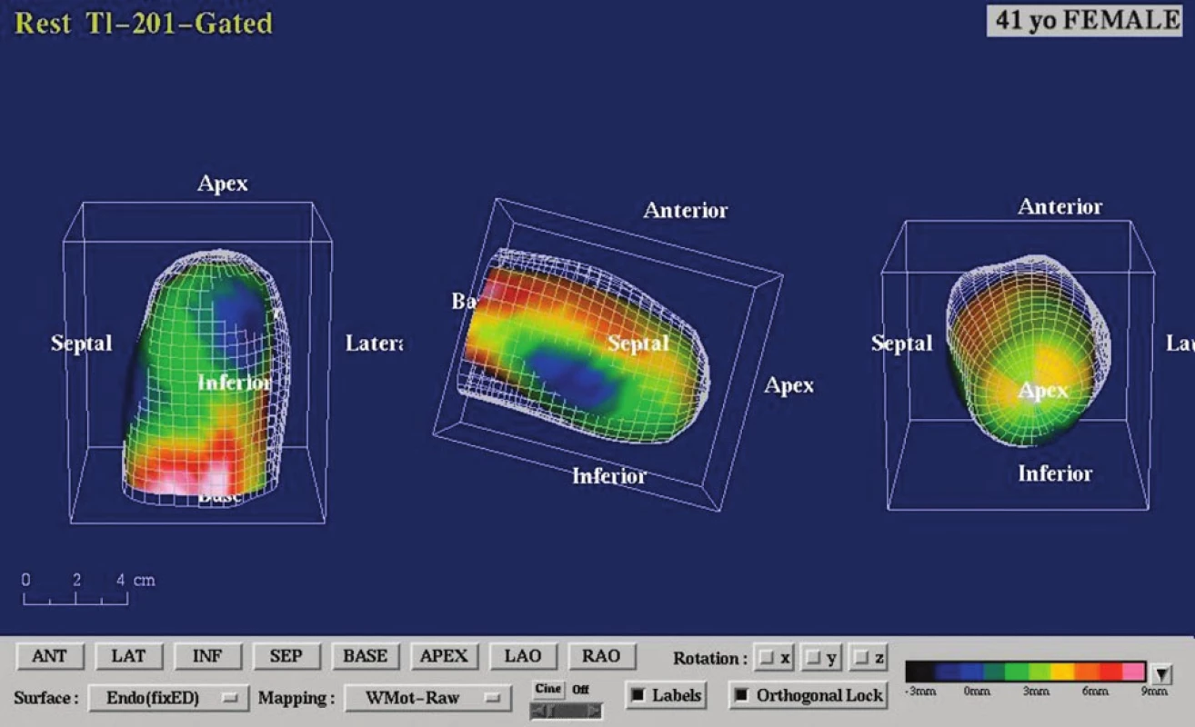 Gated SPECT 3D. Znázornění endokardiálního povrchu levé komory v end-diastole a end-systole s patrnou difuzní hypokinézou a akinézou hrotu (obrazová dokumentace SPECTu myokardu s popisem – doc. MUDr. M. Kamínek, Ph.D., Klinika nukleární medicíny, FN Olomouc).