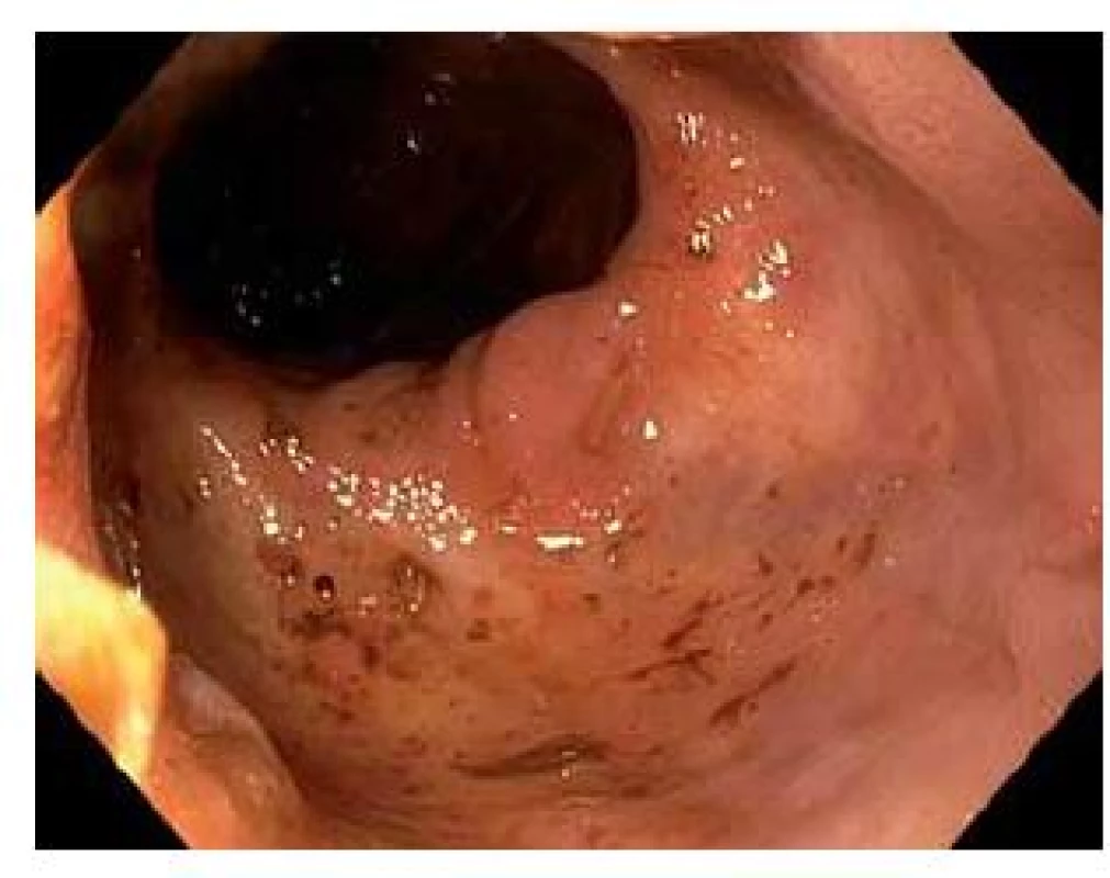 Zhojený cuff při léčbě mesalazinovými čípky.
Fig. 4. Mucosa in cuff healed by means of mesalazin suppository.