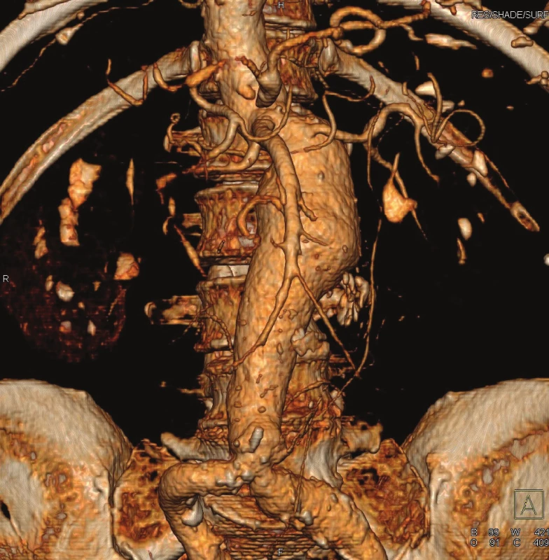 CTA předoperační nález
Fig. 2: CTA preoperative finding