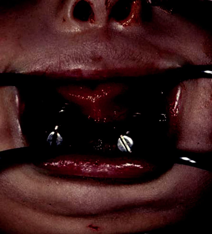 Specific intraoral distractor on a patient with the Treacher Collins syndrome