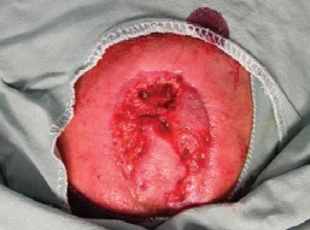 Necrectomy. Source: archive of authors.