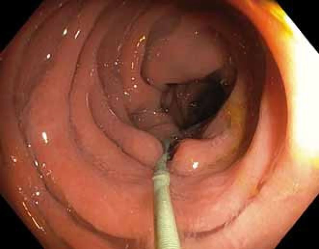 Desuflace během vytahování koloskopu.
Fig. 4. Colonoscope withdrawal with decompression.