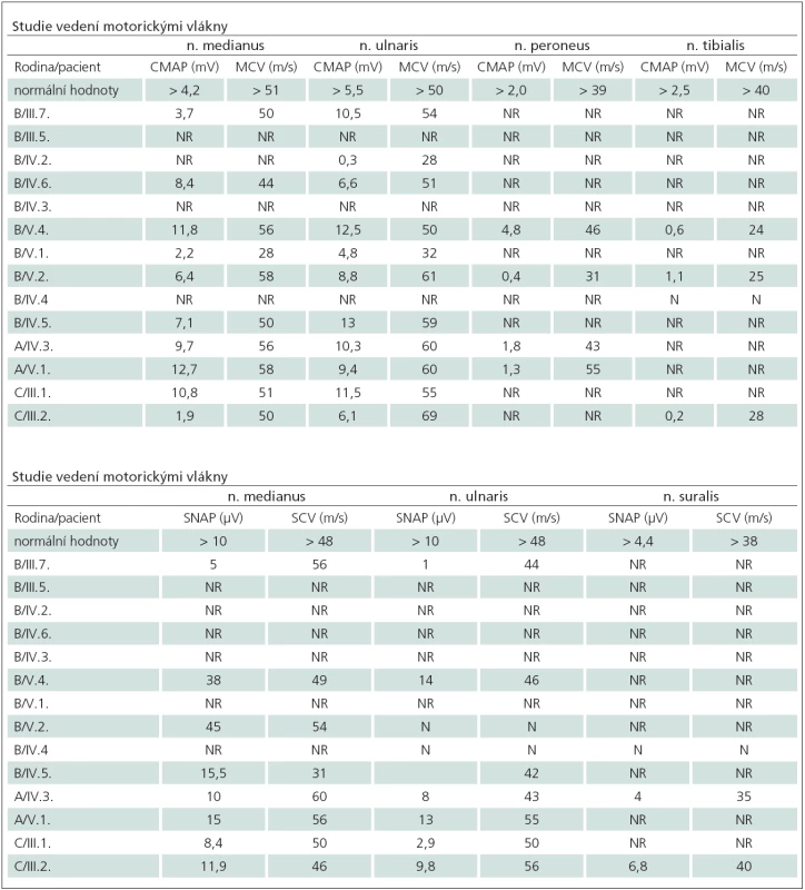 Elektrofyziologické nálezy u pacientů se senzitivní neuropatií.