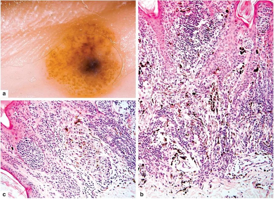 Klonální névus
a – v dermatoskopickém obrazu je modré ložisko na podkladě silněji pigmentovaných struktur v koriu
b, c – toto ložisko je tvořeno skupinami silněji pigmentovaných melanocytů s melanofágy