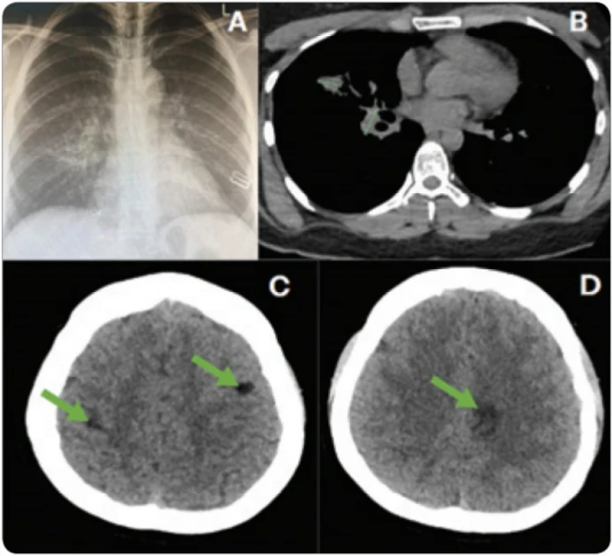 Early treatment response 3 months post-therapy (February 2024). 