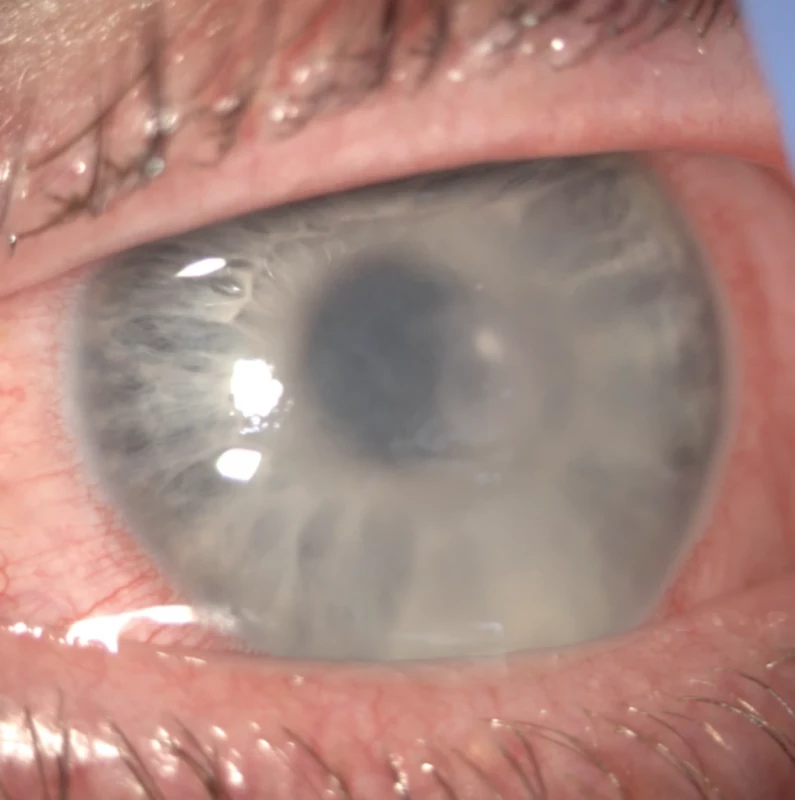 Baseline image of the anterior segment of the left eye in the case report patient. Reduced transparency and corneal edema with disciform infiltrate in the deep stroma are present