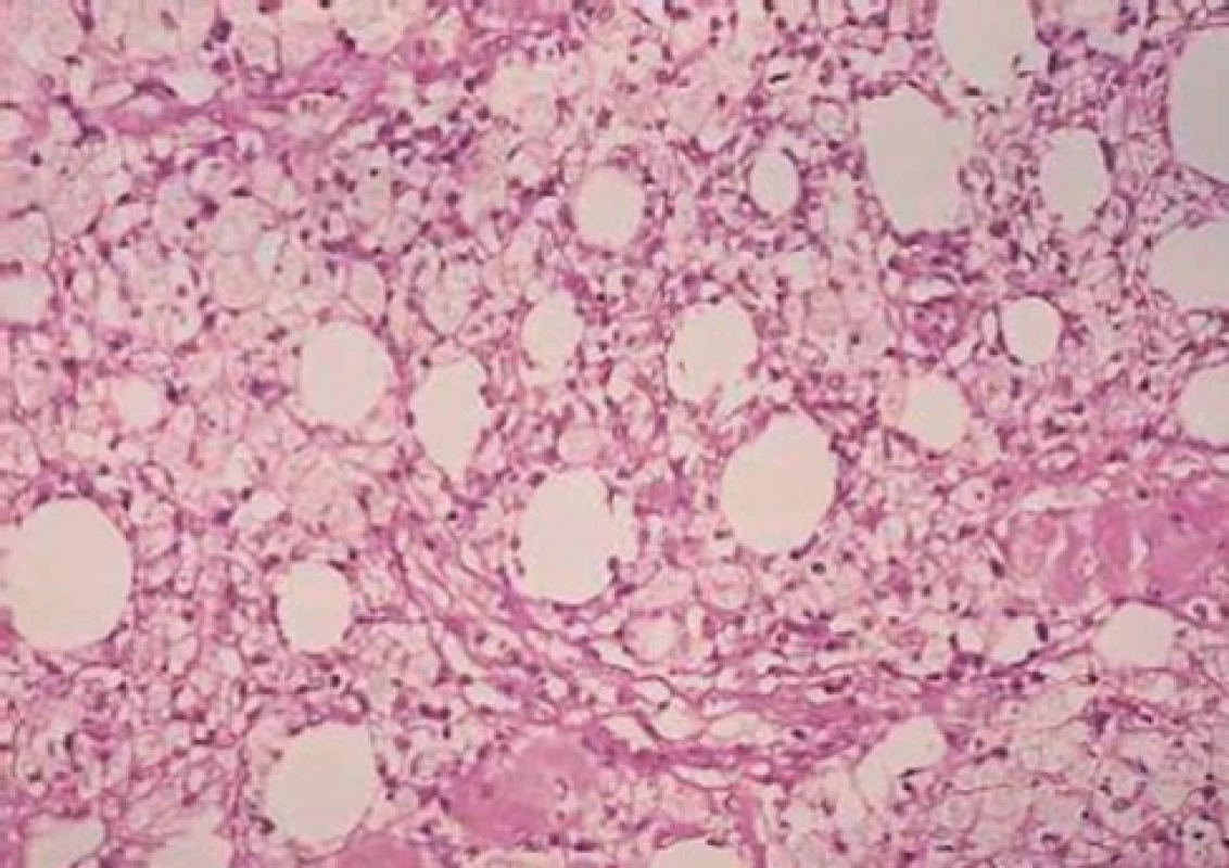 LEP – histologický obraz – rozsáhlý lobulární infiltrát složený z lymfocytů (převzato z 37)