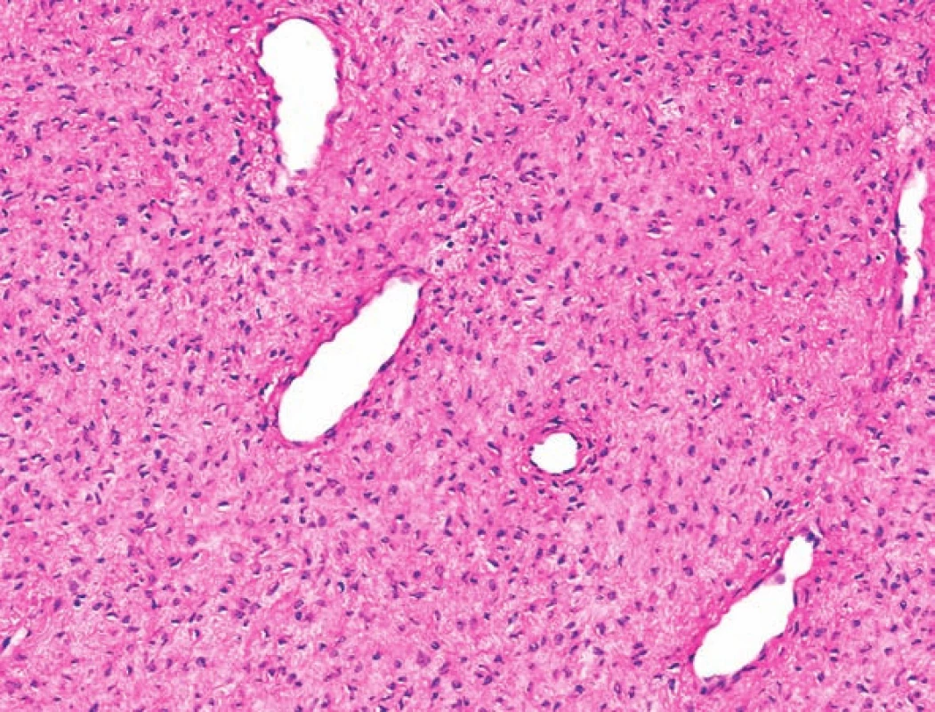 Histologicky jde o cévnatý nádor. Jsou patrné protáhlé cévní průsvity. Nádor je tvořen poměrně uniformními vřetenitými nebo oválnými buňkami uloženými v edematózním stromatu. Buněčné atypie ani mitózy nejsou přítomny. (Původní zvětšení 40×, barveno HE.)