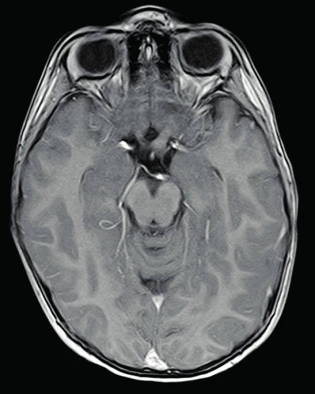 Gliom levého optického nervu, T1 postkontrastní zobrazení 
Fig. 1. Glioma of the left optic nerve, T1 postcontrast-enhanced