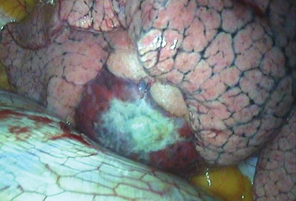 Peroperačný nález pneumatokély v dolnom laloku pravých pľúc
Fig. 3: Perioperative finding of pneumatocele in the lower lobe of the right lung