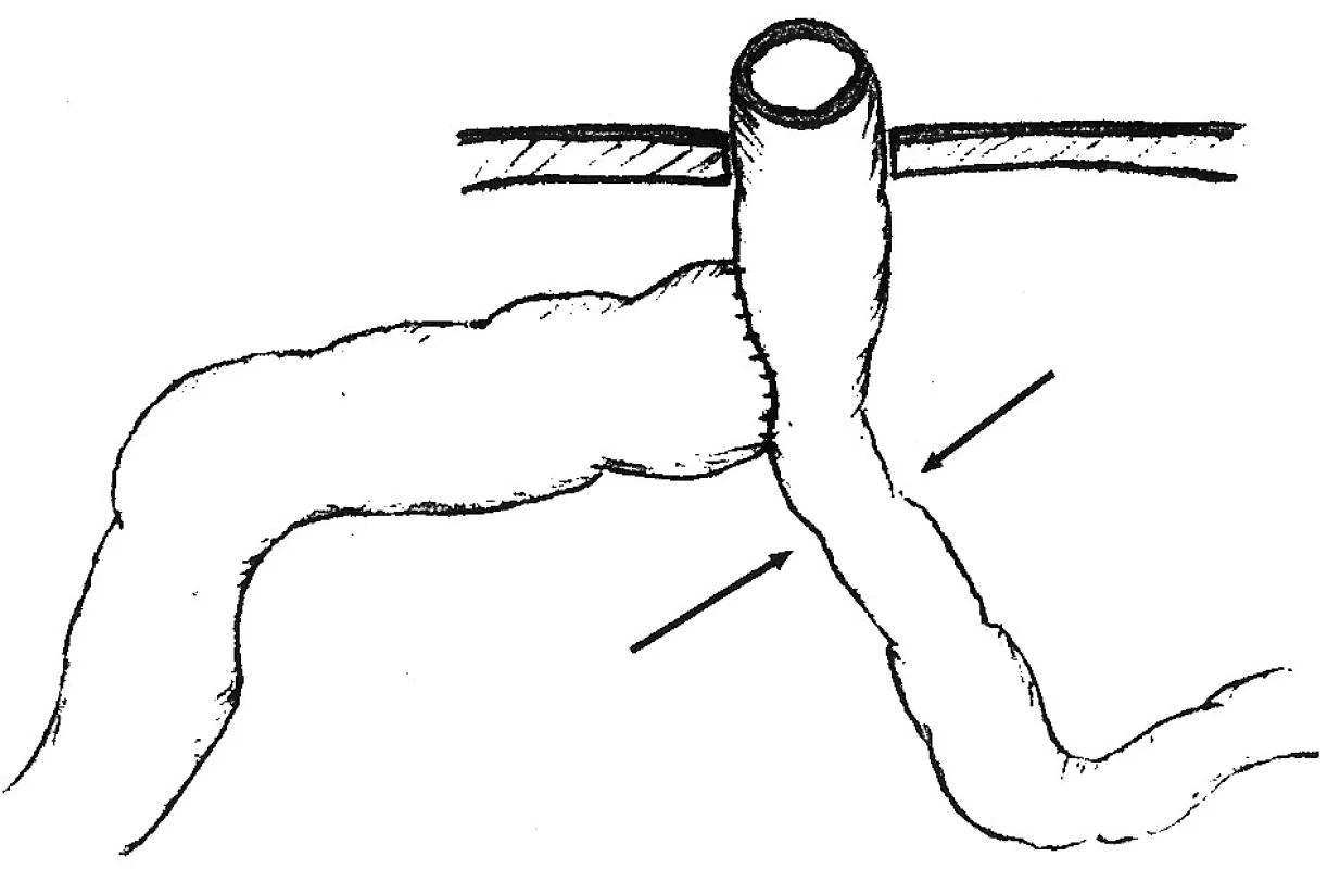 Bishop-Koopova Roux Y anastomóza s vyznačením limitujúceho lievika pasáže. Stomovaný je hypoplastický aborálny segment
Fig. 5. The Bishop-Koop Roux Y anastomosis with the restricting narrowed part demarcated. The stoma procedure is performed on the hypoplastic aboral segment.