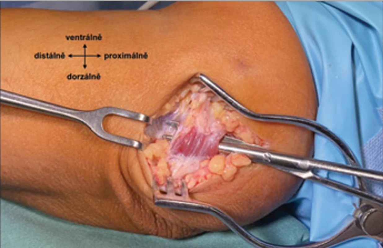 Intraoperační nález musculus epitrochleoanconeus. Fig. 9. Intraoperative fi nding of musculus epitrochleoanconeus.
