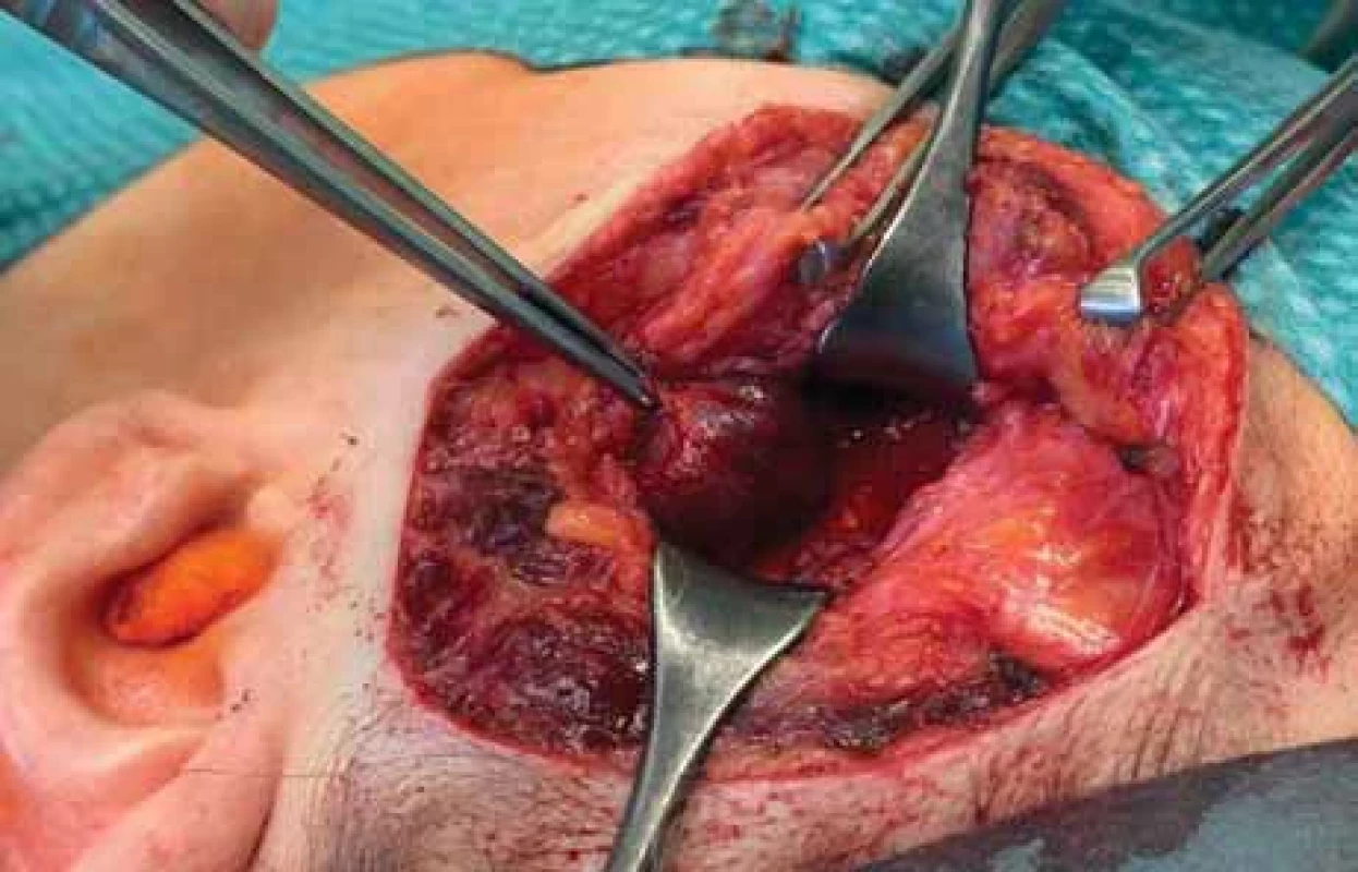 Intraoperační pohled na exponovaný hemangiom, přístup z řezu na hranici vlasaté části hlavy.