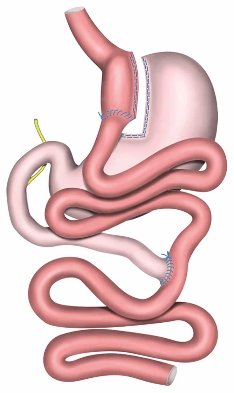 Gastrický bypass na exkludovanou Roux Y kličku jejuna (RYGB)    Fig. 1: Roux en Y gastric bypass (RYGB)
