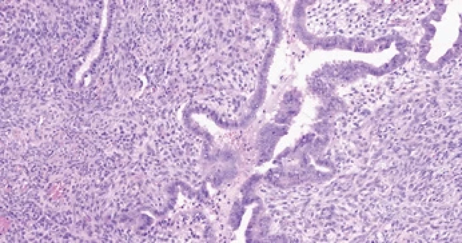 Histologický nález – mülleriánský adenosarkom dělohy, low-grade. Smíšený epitelově-mezenchymální nádor, jehož stavba silně připomíná phylloides tumor prsní žlázy.