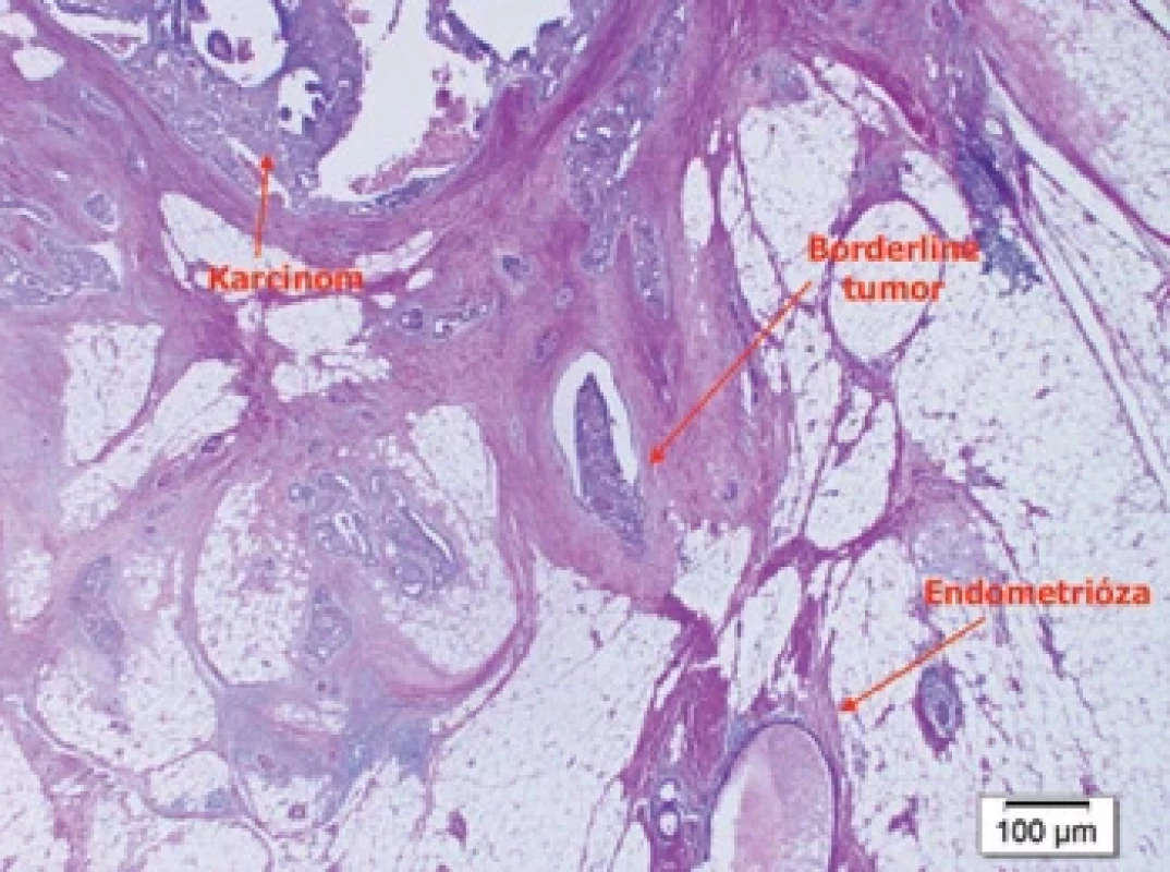 Histopatologický nález – maligní transformace. Fig. 7. Histopathological fi nding – malignant transformation.