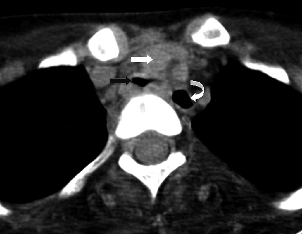 Nativně provedené CT horního mediastina v úrovni odstupů aortálního oblouku
Truncus brachiocephalicus (bílá šipka), trachea (černá šipka) a jícen (zahnutá šipka) v červnu 2007