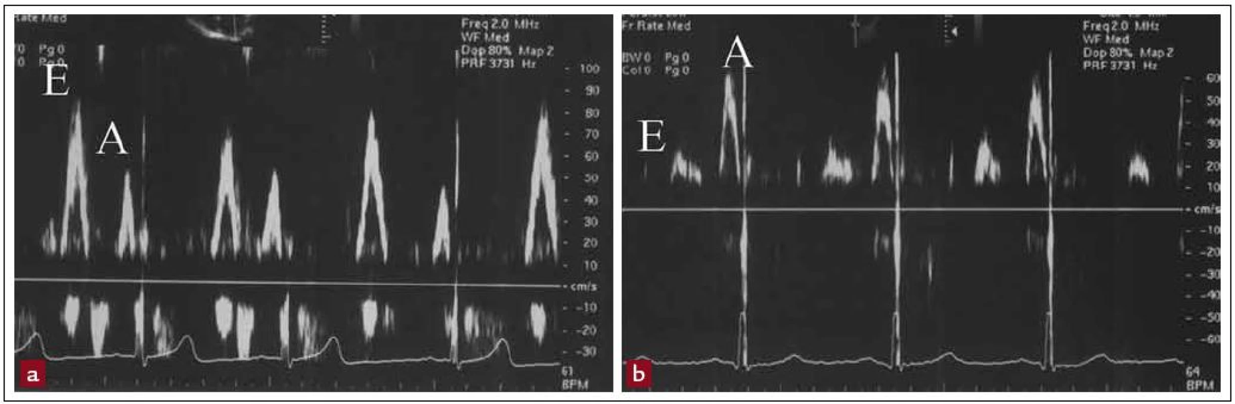 Dopplerovské hodnocení diastolické funkce: a) normální E > A, b) porucha diastolického plnění E < A.