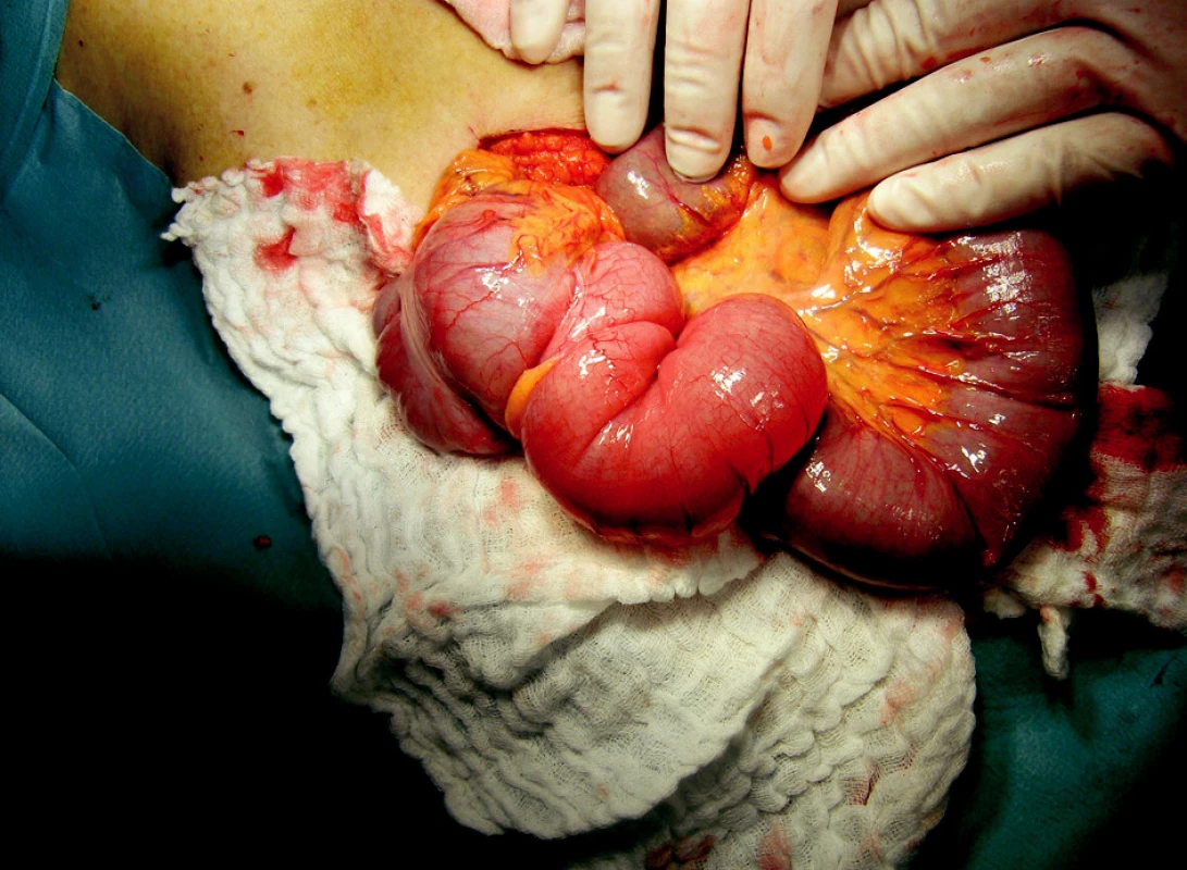 Peroperační nález ileocekální invaginace
Fig. 3. Peroperative finding of the ileocoecal invagination