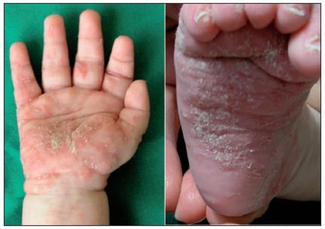 Scabies crustosa hyperkeratózy a chodbičky (Danilla T.)