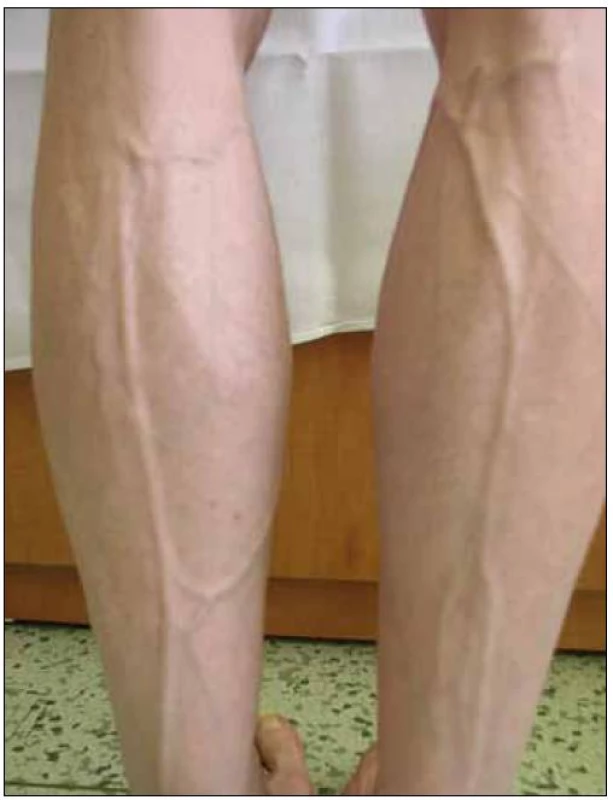 Lipoatrofie – prominence povrchových žil na dolních končetinách.