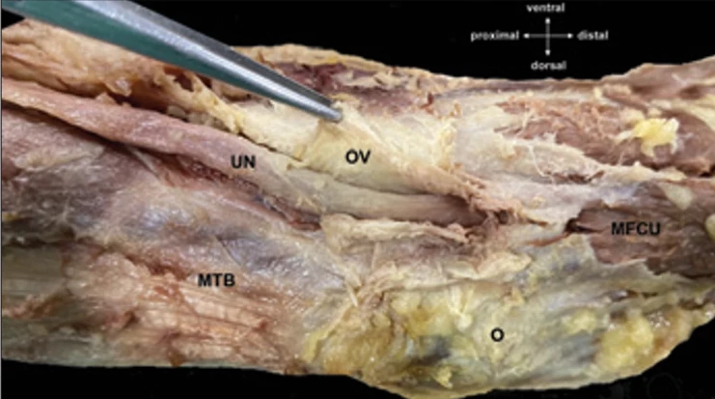 V pinzetě protnutý Osbornův vaz a pod ním odkrytý nervus ulnaris.  Fig. 5. Forceps holding the severed Osborne‘s ligament, revealing the underlying ner vus ulnaris.