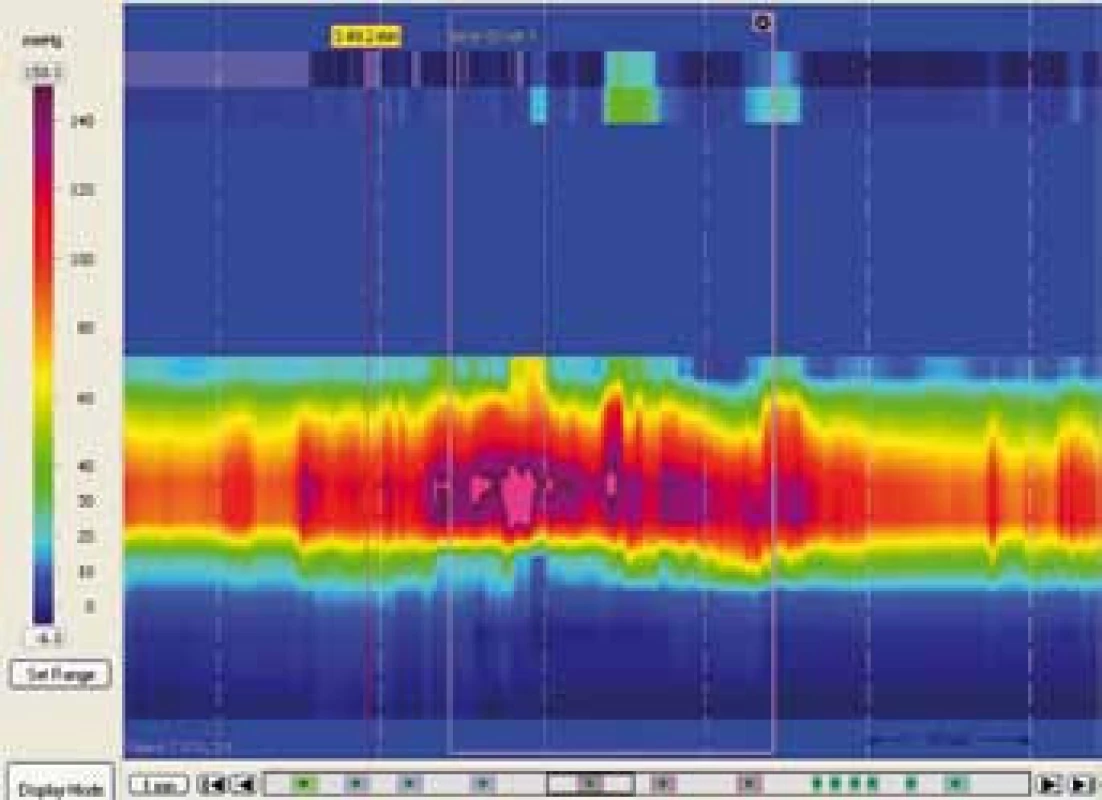 Dysynergní defekace typu I – paradoxní kontrakce análního svěrače při simulované defekaci.
Fig. 11. Dyssynergic defecation type I – paradoxical anal sphincer contraction in simulated defecation.