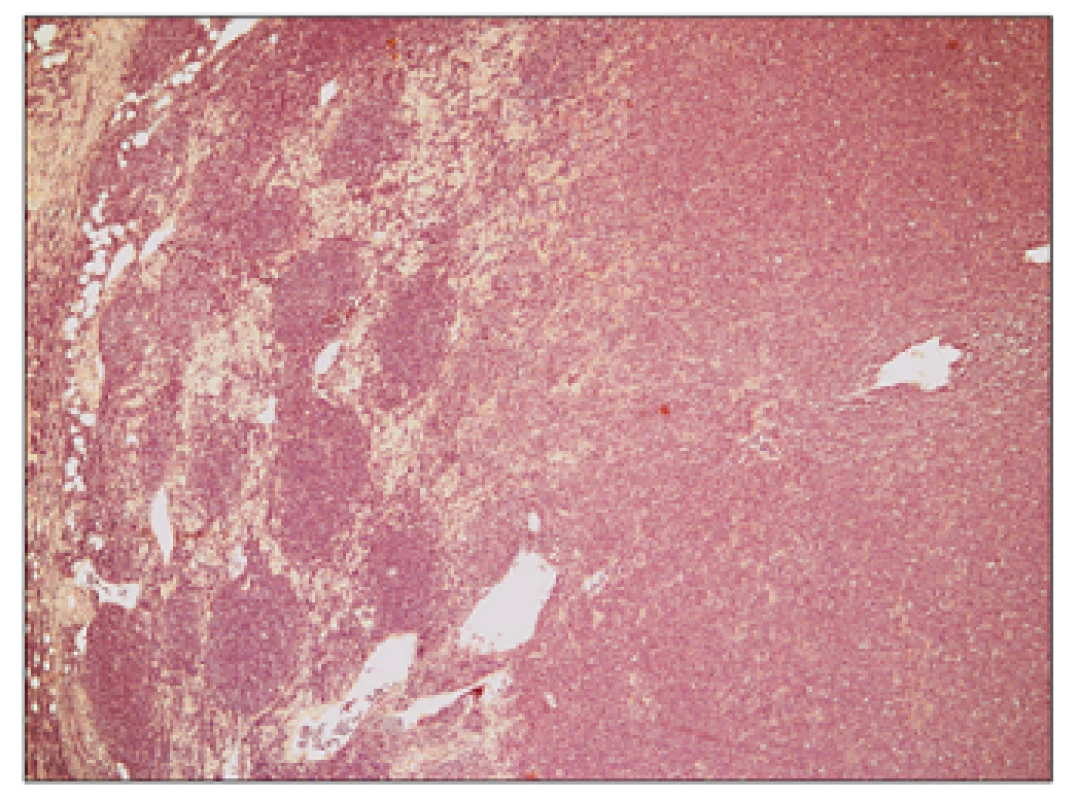 Folikulární lymfom transformovaný do DLBCL, hematoxylin – eosin, zvětšení 50x.