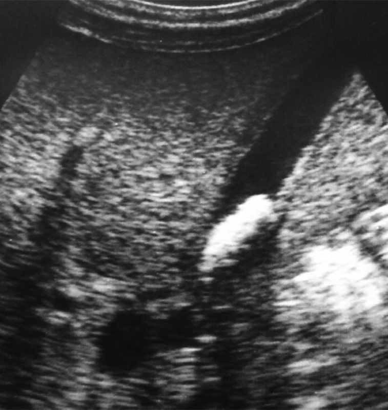 USG obraz klasickej cholecystolitiázy (kompaktný, hyperechogénny a pohyblivý útvar
v lumene žlčníka s distálnym akustickým tieňom). Predčasne narodený novorodenec (30. gestačný týždeň) s perinatálnou infekciou a popôrodnou respiračnou insuficienciou vyžadujúcimi
antibiotickú liečbu, distenčnú liečbu, umelú pľúcnu ventiláciu a oxygenoterapiu, po fototerapii
pre hyperbilirubinémiu a po opakovaných transfúziach pre anémiu.
Fig. 1. USG image of classical cholecystolithiasis (compact, hyperechogenic and movable formation in the gall bladder lumen with distal acoustic shadow). Premature newborn (30th gestational week) with perinatal infection and postpartum respiratory insufficiency requiring antibiotic therapy, distension treatment, artificial lung ventilation and oxygen therapy, after phototherapy for hyperbilirubinemia and repeated transfusions for anemia.