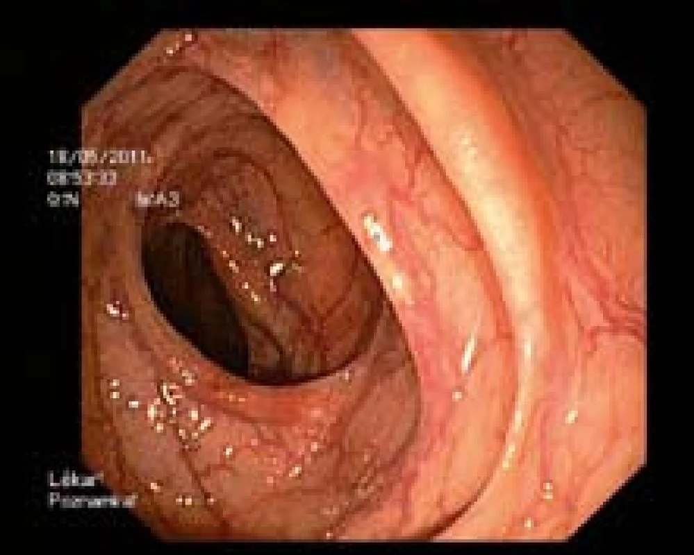Stupeň střevní přípravy: A, vynikající.
Fig. 1. The level of bowel preparation: A, very good.