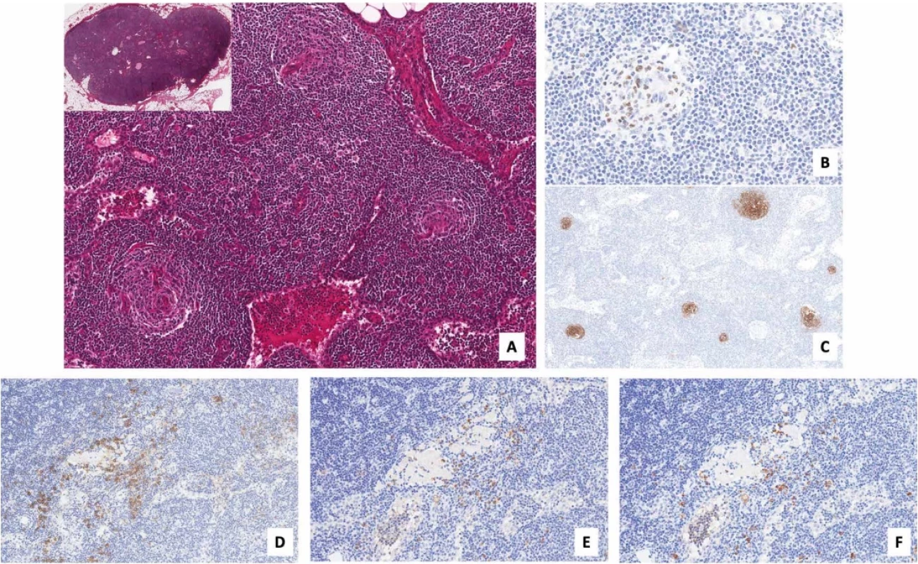 Histological features of the excised lymph node.