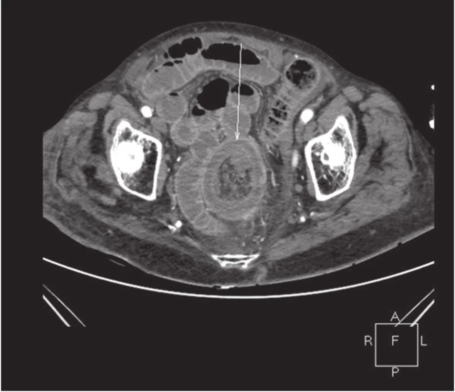 CT obraz invaginace v oblasti colon sigmoidei axiální řez
Fig. 2: CT image of invagination in the sigmoid colon area, axial section