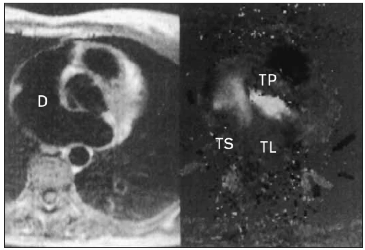 MRI defektu septa síní. Levý panel spin echa v transaxiální rovině ukazuje defekt (D). Pravý panel ukazuje v téže rovině rychlostní mapu, která jasně zobrazuje tok defektem.