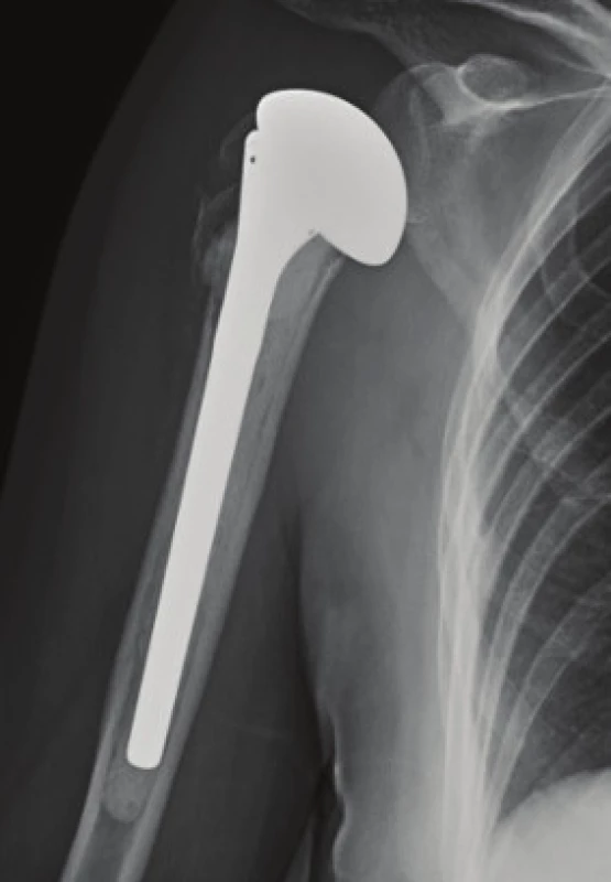 RTG obraz implantace hemiartroplastiky 3 měsíce od operace