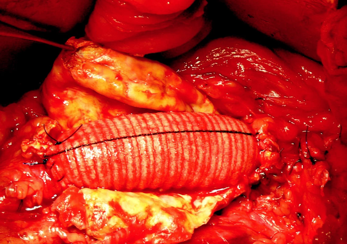 5. Resekce AAA s A-A náhradou z extraperitoneálního přístupu
Fig. 5. Resection of the AAA with A-A implantation performed using the extraperitoneal approach