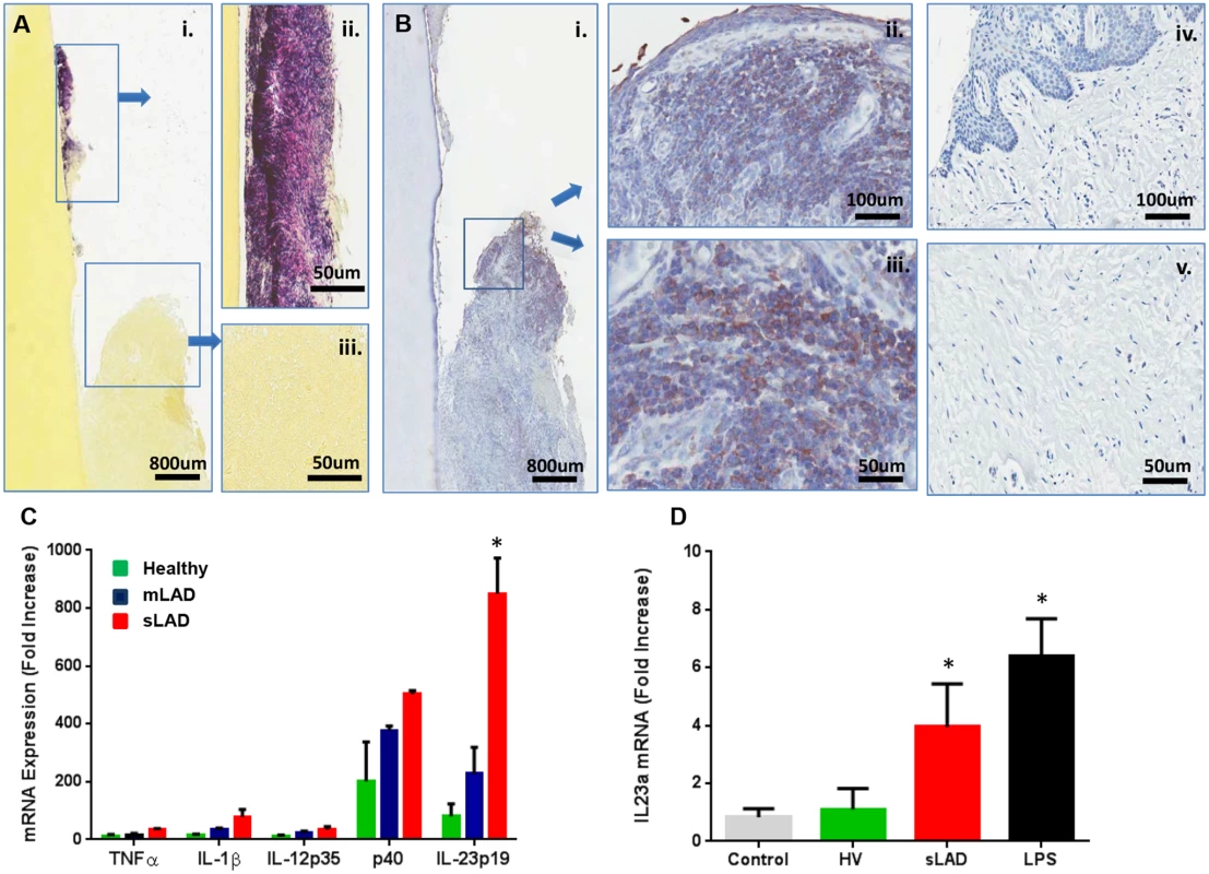 Immunostimulatory potential of LAD- associated dental plaque.