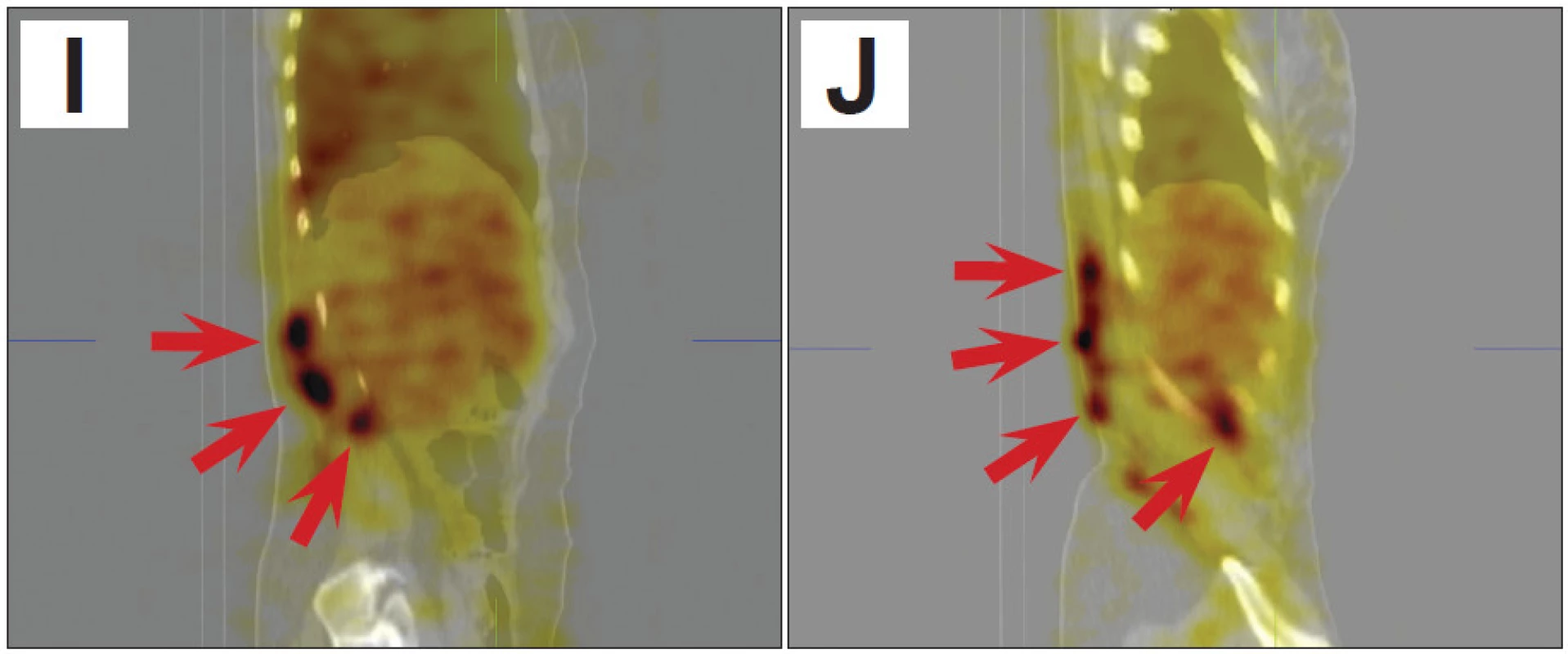 SPECT/CT obrazy trupu umožní přesnější posouzení lokalizace a rozsahu hemangiomu (šipky).
A 3D obraz v předním pohledu
B 3D obraz v pravém bočním pohledu
C 3D obraz v pravém zadním šikmém pohledu
D řez v transverzální rovině v dolní části hrudníku
E řez v transverzální rovině v úrovni beder
F řez v transverzální rovině v úrovni pánve
G řez ve frontální rovině dorzálně v oblasti páteře
H řez ve frontální rovině dorzálně v oblasti zadní stěny trupu
I řez v sagitální rovině parasagitálně od střední čáry vpravo
J řez v sagitální rovině laterálně vpravo