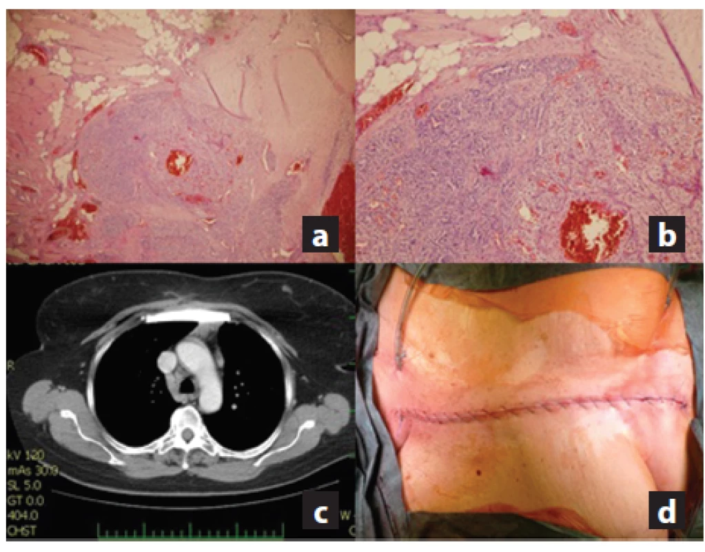 a,b,c,d: a) Definitivní histologie v barvení hematoxylinem-eosinem zobrazující metastázu renálního papilárního karcinomu (zvětšení 40x); b) Hematoxylin-eosin (zvětšení 100x); c) Kontrolní snímek půl roku po provedené náhradě zobrazující náhradu sterna; d) Sutura kůže po resekci sterna.
Fig. 6 a,b,c,d: a) Definitive histology of renal papilary carcinoma metastasis stained with hematoxylin-eosin (40x zoomed); b) Hematoxylin- eosin (100x zoomed); c) Follow-up CT image taken 6 months after resecion showing the sternal replacement; d) Final skin suture after resection .