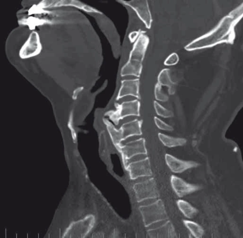 Předoperační CT, sagitální snímek (kazuistika 1).
Fig. 2. Preoperative CT, sagittal image (a case report 1).