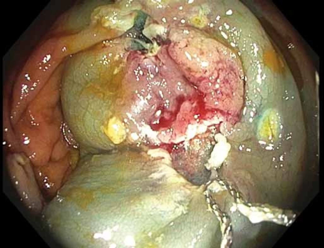 Endoskopická slizniční resekce okrajových částí léze s příznakem „liftingu“.
Fig. 4. Endoscopic mucosal resection of lifted marginal parts of the lesion.