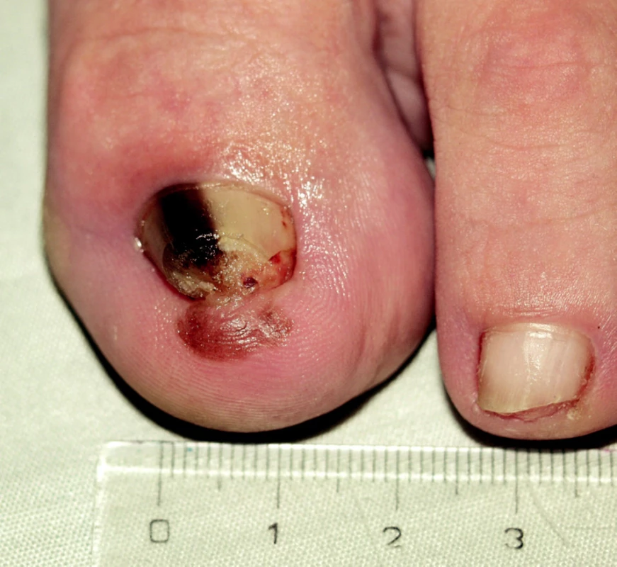 Akrolentiginózní melanoma in situ, Hutchinsonovo znamení.