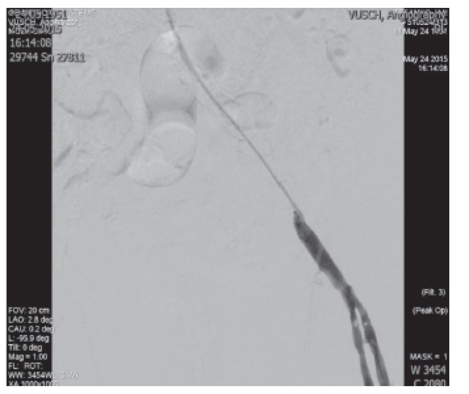 Umiestnenie katétra pre mechanickú trombektómiu AIE l.sin.
Fig. 4: Catheter placement for mechanical thrombectomy AIE l.sin.