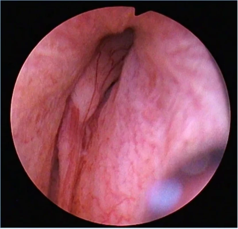 Uretrocystoskopie IUP, pohled do uretry. Fig. 1. IUP urethrocystoscopy, view of the urethra. 