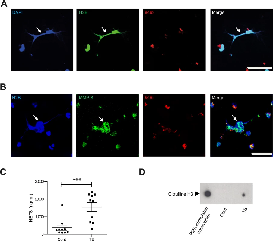 Neurophil MMP-8 associates with NETs.