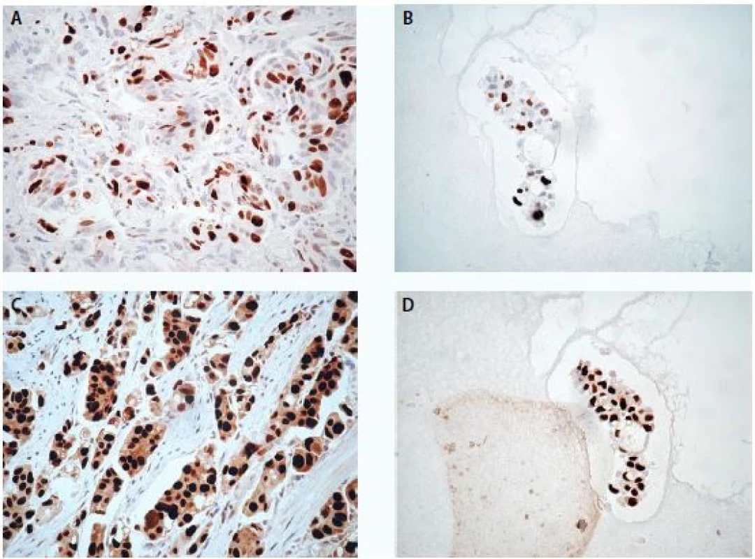 High-grade uroteliální karcinom, imunochemické vyšetření markeru Ki-67 ve tkáni (A) a v cytobloku (B)
a markeru p53 ve tkáni (C) a v cytobloku (D), zvětšení 400×<br>
Fig. 2. High-grade urothelial carcinoma, expression of Ki-67 in tissue section (A) and in cell block section (B) and
expression of p53 in tissue section (C) and in cell block section (D), magnification 400×